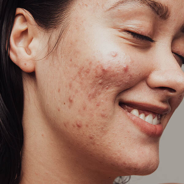 Acne